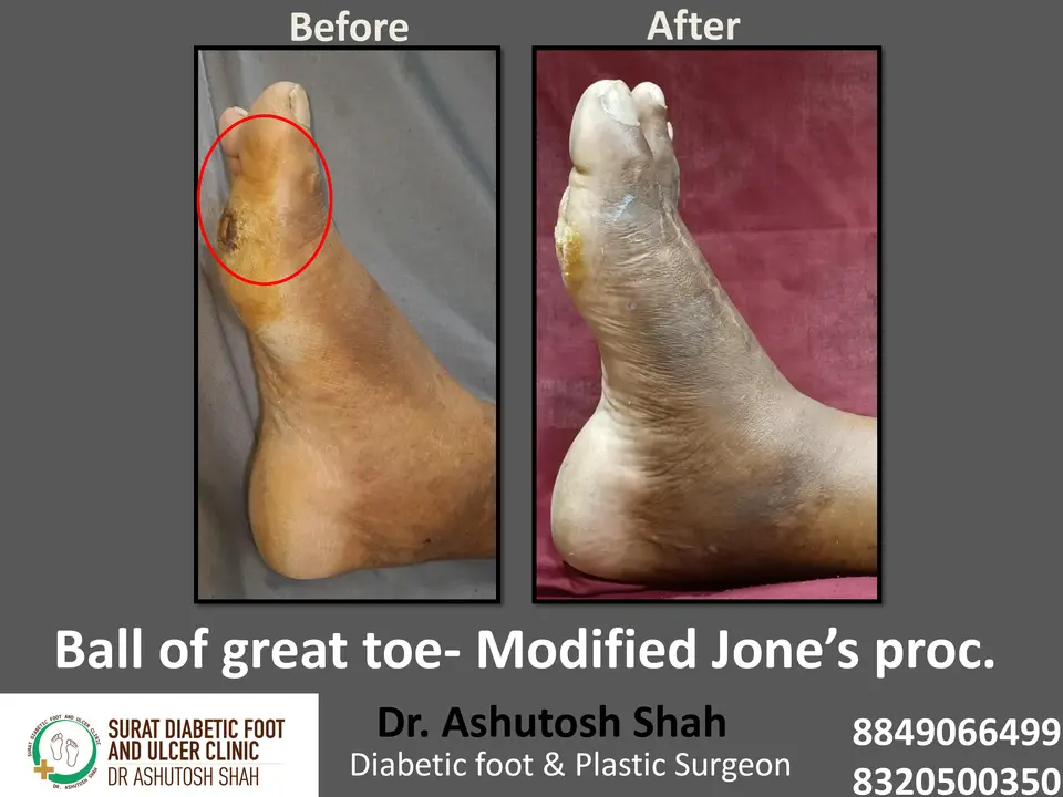 Diabetic Foot  PPT 3 checked by sir.pptx-44.webp